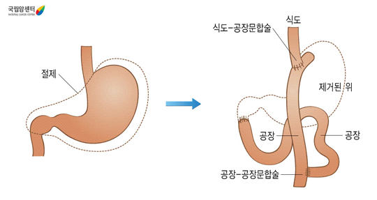 위전절제술후의 소화기계 구조