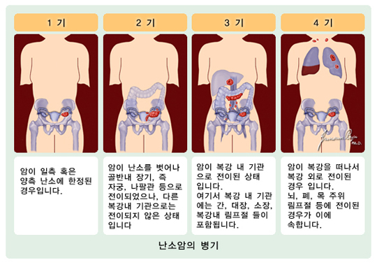 난소암의 병기