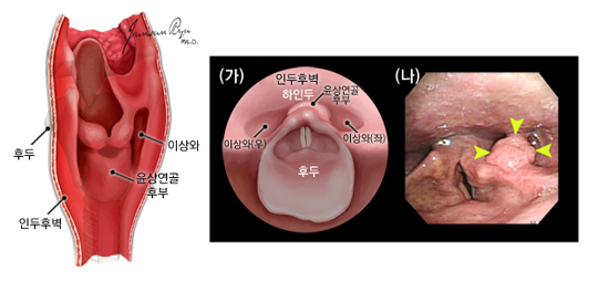 하인두의 정상 내시경 소견과 하인두암