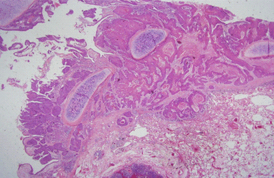 폐편평상피세포암의 병리사진