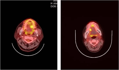 좌측, 우측 설암의 양전자방출단층 촬영 이미지