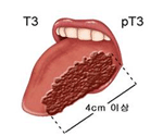 설암(T3)
