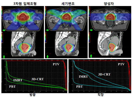 전립선암 환자 CT 단면(위 패널)과 측면(아래 패널)의 3차원 입체조형(3D-CRT), 세기변조(IMRT), 양성자치료(PBT)의 선량분포 예시