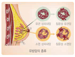 국민 암예방 수칙 실천 지침-유방암의 종류