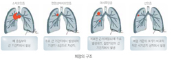 국민 암예방 수칙 실천 지침 - 폐암의구조