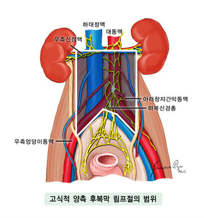 고식적 양측 후복막 림프절의 범위