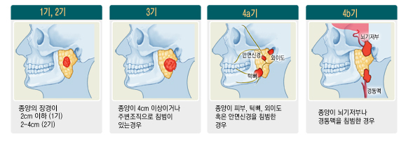 침샘암의 진행단계