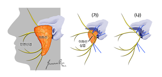 이하선종양의 수술
