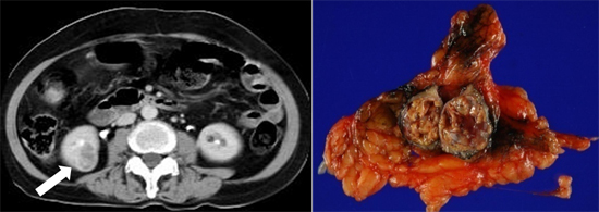 우측 신세포암의 전산화단층촬영 사진 및 부분 신절제술 후의 육안사진