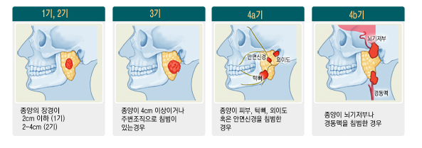 침샘암의 진행단계