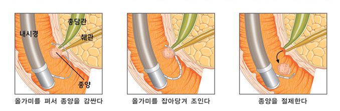 내시경 유두부 절제술의 모식도