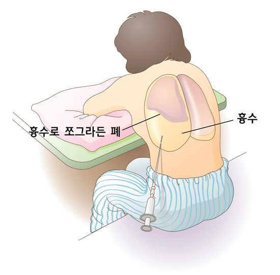 흉수천자법