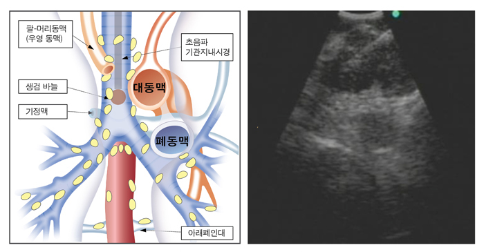 초음파 기관지내시경