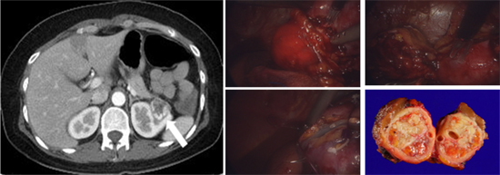 좌측 신세포암의 전산화단층촬영 사진 및 복강경하 부분 신절제술 사진, 육안조직 사진