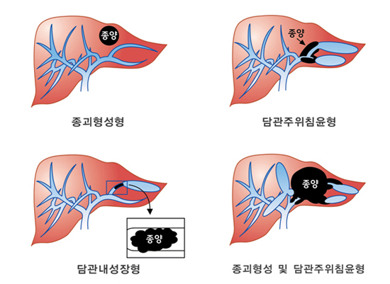간내 담관암의 종류