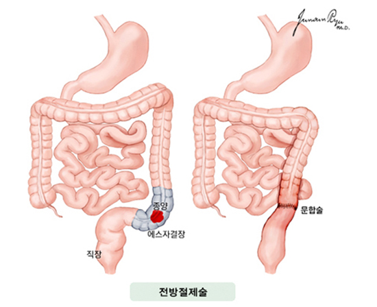 전방절제술