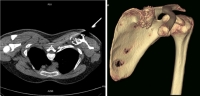 좌측 견갑골에 발생한 연골육종에 대한 전산화단층촬영(CT)유도하 생검 모습과 3차원 재구성 CT