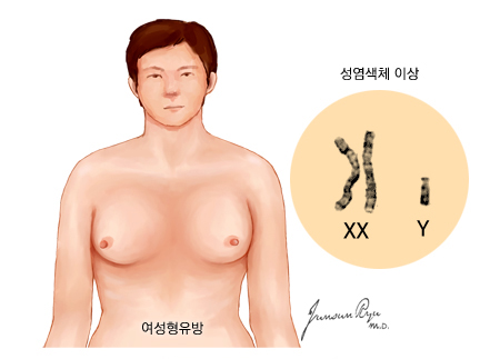 클라인펠터 증후군
