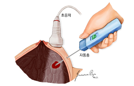 초음파 유도하 자동총 중심생검