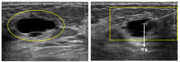 세침흡인 세포검사 초음파 사진과 세침흡인 세포검사 시술 사진