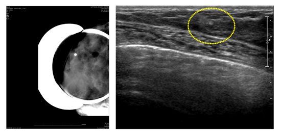 맘모톰 조직 검사 맘모그램 사진과 맘모톰 조직 검사 초음파 사진