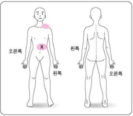 통증의 부위표시 예 - 환자의 통증을 관리하기 위해서는 첫째로 통증부위가 어디인지를 정확히 나타내는 것이 중요합니다. 신체의 그림을 통해 통증부위에 원이나 점으로 표시하고 그중에서 통증이 가장 심한 부위에는 X표로 표시하면 됩니다.