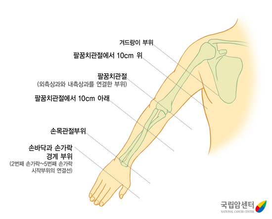 팔 둘레 측정부위 - 팔둘레 측정은 겨드랑이 부위, 팔꿈치 관절에서 10cm 위, 팔꿈치 관절, 팔꿈치 관절에서 10cm아래, 손목 관절 부위, 손바닥과 손가락 경계 부위를 재서 전과 비교합니다. 