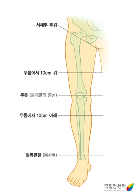  다리 둘레 측정부위 - 다리둘레 측정은 서혜부 부위, 무릎에서 10cm 위, 무릎, 무릎에서 10cm 아래, 발목관절을 재서 전과 비교합니다. 