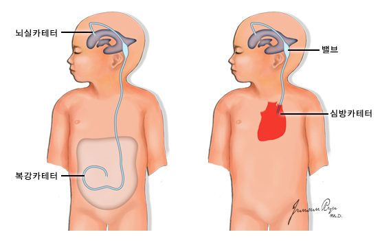 뇌실 복강간 션트(좌)와 뇌실 심방간 션트(우) - 뇌실 복강간 션트와 뇌실 심방간 션트는 뇌 아닌 다른 복강 또는 심방으로 뇌척수액을 우회시켜 흡수시키는 방법입니다.