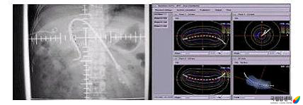 간담도암의 근접치료 예(관내치료)