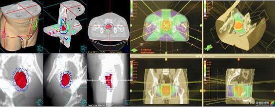 3차원 입체조형 방사선 치료의 예 - 진단영상으로 사용되는 CT나 MRI를 이용하여 입체적으로 분석하여 종양부위를 정확하게 재구성할 수 있는 치료입니다. 적응증으로는 특히 뇌종양, 두경부종양, 폐암을 비롯하여 간담도 및 골반 부위의 종양 등 다양하게 적용됩니다.