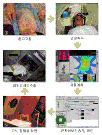 정위방사선수술과정 - 정위 방사선수술 과정은 환자를 고정한 뒤 영상을 획득합니다. 그리고 치료를 계획하고 환자 정보 전송 및 확인 후 정밀성을 확인합니다. 마지막으로 정위방사선수술을 실시합니다.