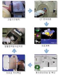 분할 정위 방사선 치료 과정 - 분할정위 방사선 치료과정은 고정기구제작 후에 CT모의치료를 합니다. 이후 치료계획, 환자 정보전송 및 확인을 하고 마지막으로 분할정위방사선치료를 하게됩니다