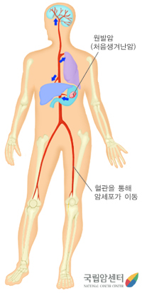 원발암의 최초위치와 혈관을 통해 암세포가 이동되는 인체그림