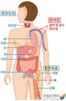 암의 발생부위 - 일반적으로 암은  인간의 신체 중 어느 부위에서든지 발생할 수 있습니다. 흔한암종으로는 갑상선암, 폐암, 유방암, 간암, 위암, 대장암, 자궁암이 있습니다. 혈액암은 혈액 및 골수, 림프절에 발생하는 것을 의미합니다. 그리고 육종은 결체조직성 종양이라고 하는데 피부 밑이나 장기사이에 있는 지방이나 근육같은 조직종양을 말합니다