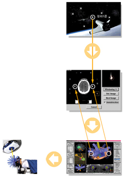 선형가속기를 이용한 정위 방사선 수술 - 선형가속기를 이용한 정위 방사선수술은 우주선이 우주에서 주변의 행성을 기준으로 하여 자신의 위치를 파악하는 기술을 이용한 방법으로 CT나 MRI를 이용하여 병소의 좌표를 구성하고, 좌표를 이용하여 방사선치료 장비의 회전중심과 병소의 중심을 일치시킨 후, 고선량의 방사선을 집중적으로 조사하는 방법입니다. 