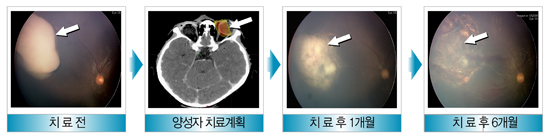 망막모세포종의 양성자 치료 사례 - 1)치료전 2) 양성자 치료계획 3) 치료 후 1개월 4)치료 후 6개월