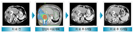 간세포암종의 양성자 치료 사례 - 1)치료전 2) 양성자 치료계획 3) 치료 후 1개월 4)치료 후 6개월