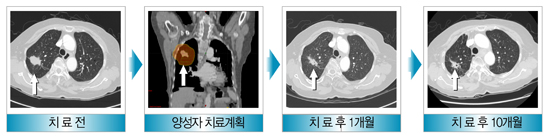 폐암의 양성자 치료 사례 - 1)치료전 2) 양성자 치료계획 3) 치료 후 1개월 4)치료 후 6개월