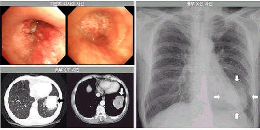 폐암의 기관지내시경검사, 흉부 CT, 그리고 단순 X선 촬영 소견