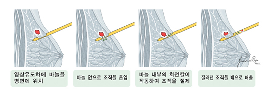 맘모톰 조직검사 순서 - 1.영상유도하에 바늘을 병변에 위치, 2.바늘 안으로 조직을 흡입, 3.바늘 내부의 회전칼이 작동하여 조직을 절제, 4.잘라낸 조직을 밖으로 배출
