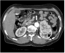 좌측 신세포암의 전산화 단층촬영 사진