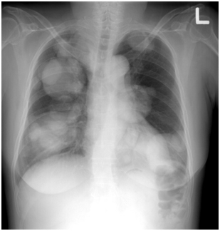 다발성 폐 전이가 있는 단순 흉부촬영 사진