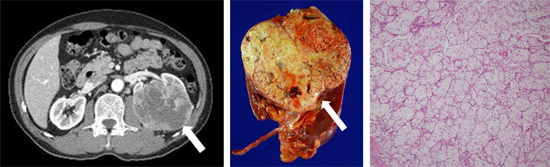 좌측 신세포암의 전산화단층촬영사진, 근치적 신적출술 후의 육안사진 및 현미경사진(제 2기의 투명세포형 신세포암)