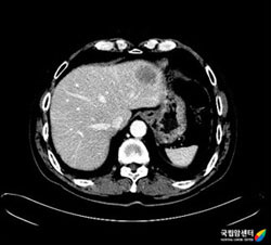 간으로 전이된 항문암의 CT 소견