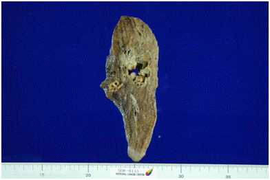 수술로 절제한 폐선암 (폐의 선암으로 좌측 폐를 절제한 육안사진소견)