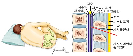 요추천자시 자세와 천자 부위- 척수, 지주막, 경질막, 지주막밑공간, 경질막바깥공간, 피부, 피부밑조직, 근막, 가시끝인대, 가시사이인대, 황색인대