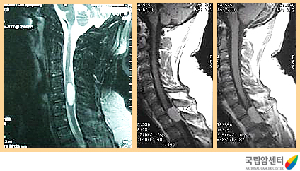 경추부와 흉추부에 발생한 경막외 수막종의 자기공명 영상 촬영 소견