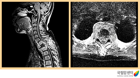 전이성 척수종양의 자기공명 영상촬영 소견