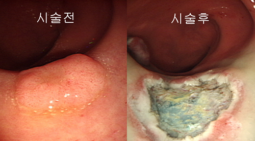 조기직장암의 내시경적 절제술 - 시술 전, 시술 후